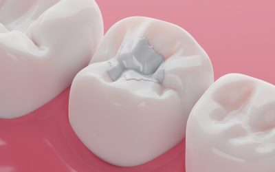 Composite Filling Procedure: Everything You Need to Know
